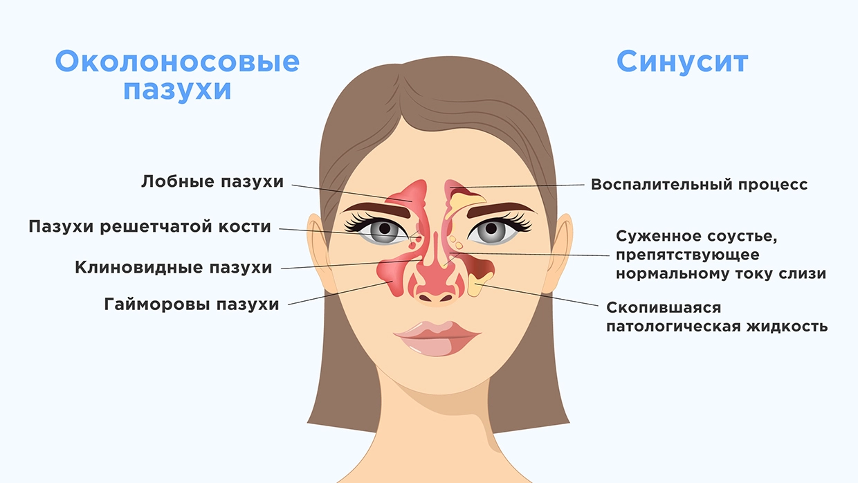 Что такое синусит, как отличить его от насморка